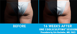Before and 16 Weeks After One CoolSculpting Session
Procedure by Eric Bachelor, MD, FACS